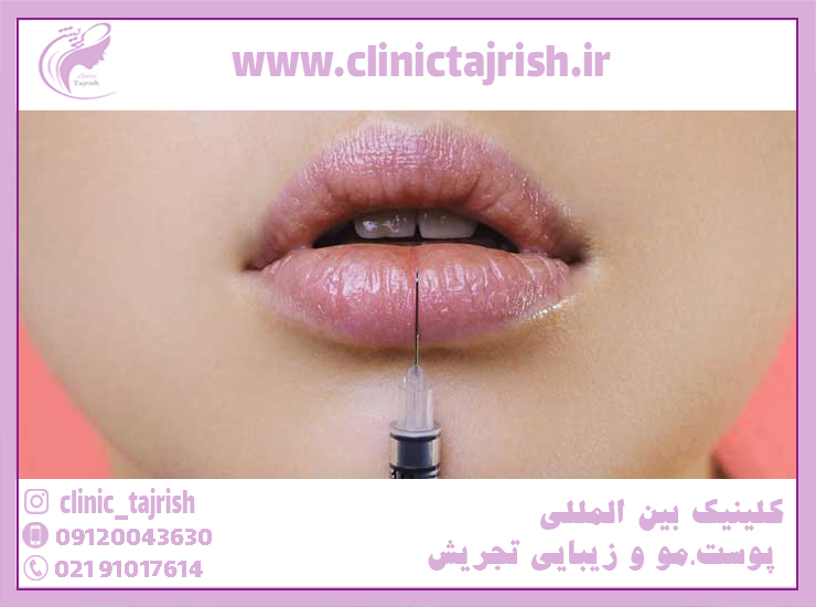 مدت ماندگاری ژل لب مدل عروسکی چقدر است؟ - دکتر جان تجریش